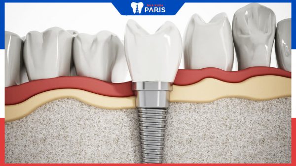 Trồng 1 răng Implant giá bao nhiêu? Yếu tố nào chi phối giá cả?