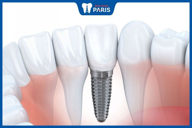 Trồng răng implant vững chắc mà vẫn tạo được hình dạng mong muốn