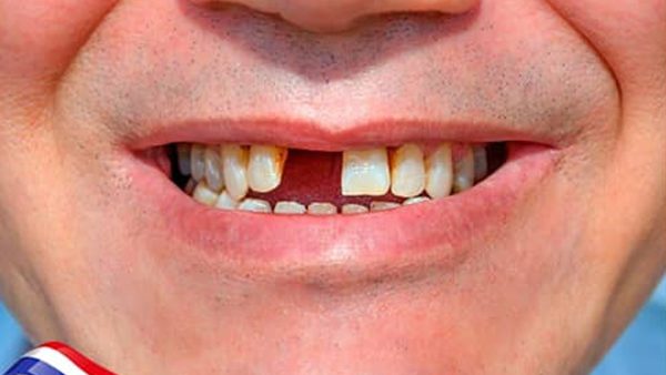 Bị mất răng có sao không, tác hại của việc mất răng