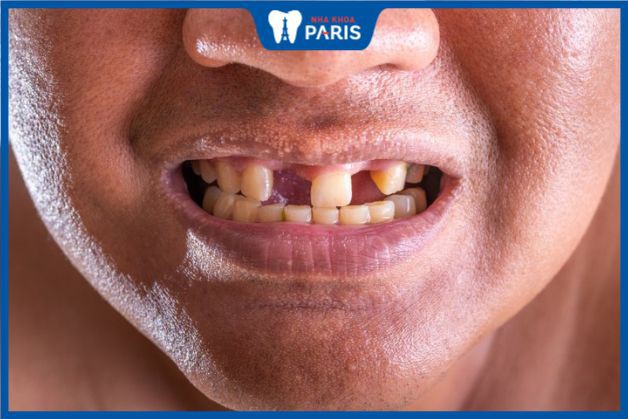 Người mất răng và vẫn đủ sức khỏe thì nên cấy ghép implant