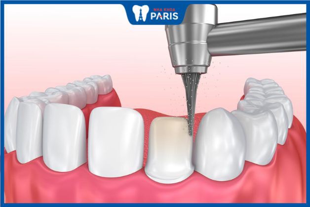 Răng implant không phải mài như phương pháp cầu răng sứ
