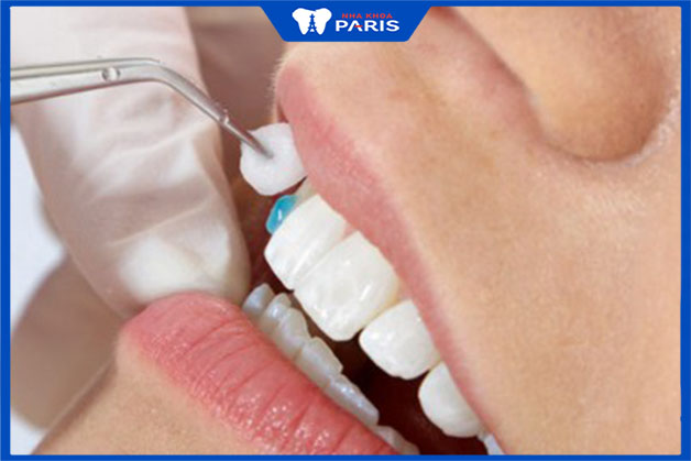 Đắp răng khểnh với phương pháp composite