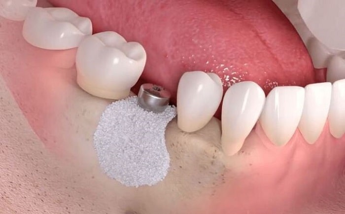 Quy trình ghép xương trồng răng Implant khép kín