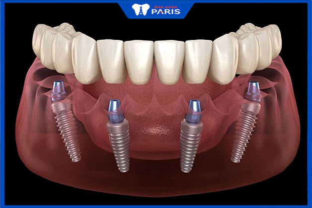 Phương pháp trồng răng implant nguyên hàm 