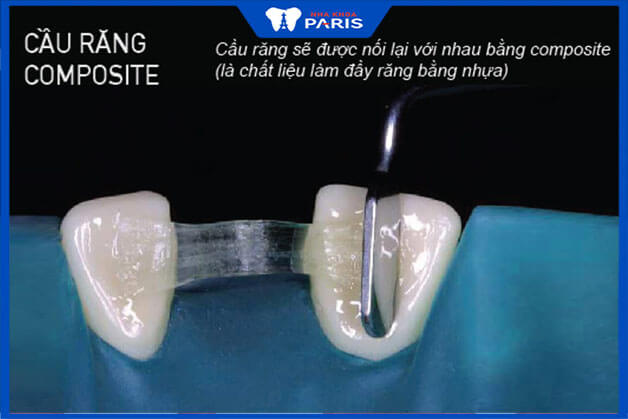 Cách làm cầu răng bằng Composite