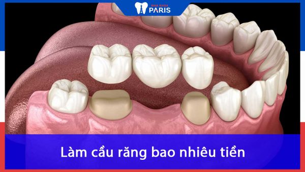 Làm cầu răng bao nhiêu tiền? Phụ thuộc vào yếu tố nào?