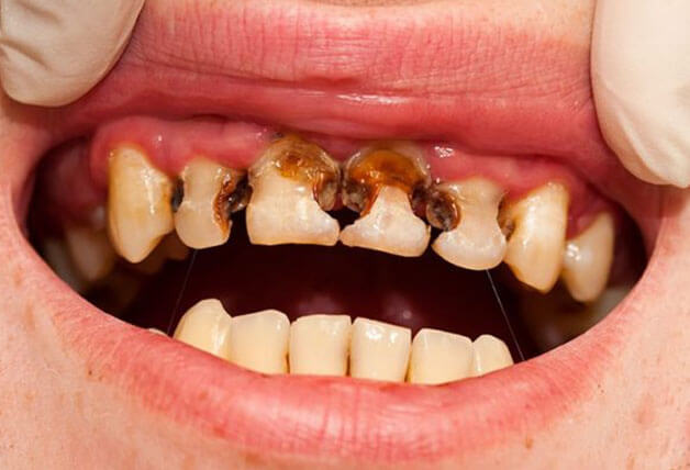 Không thực hiện chỉnh nha sẽ dễ mắc các bệnh về răng miệng