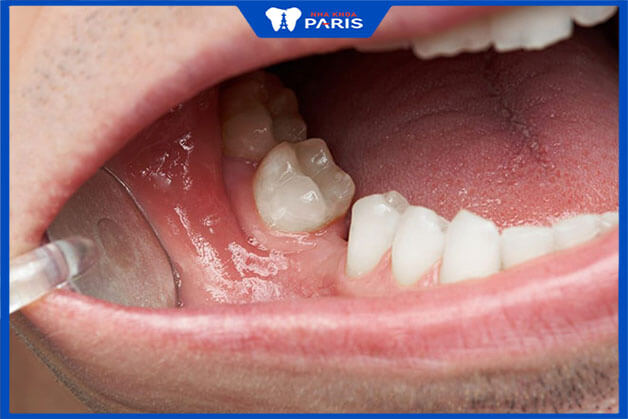 Xương hàm không còn chức năng giữ răng sẽ tiêu biến dần
