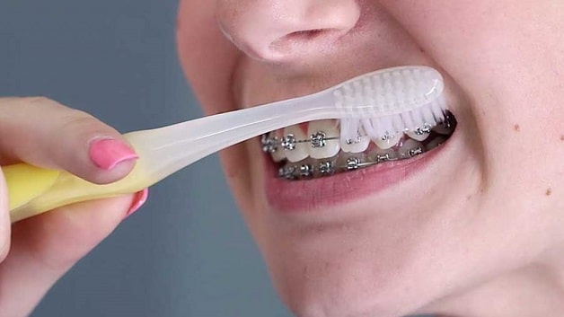 Vệ sinh răng miệng là điều cần lưu ý khi niềng răng 