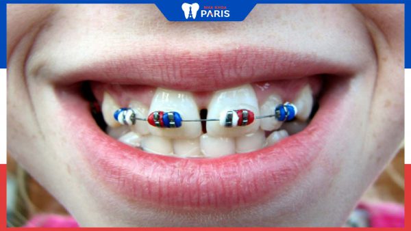 Giá niềng răng chỉnh hàm 2 răng cửa bị hô tại nha khoa paris