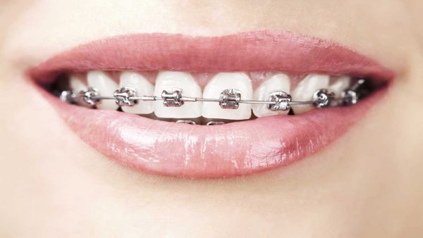 Niềng răng giai đoạn nào đau nhất? Chăm sóc sau niềng răng
