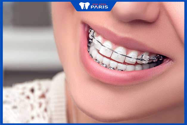 niềng răng 2 hàm giúp phát âm chuẩn hơn