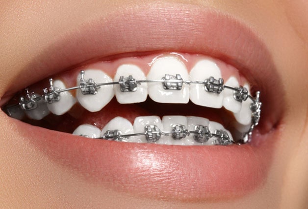 Phương pháp niềng răng kim loại