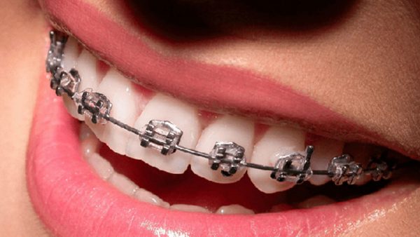 Niềng răng 1 hàm có hiệu quả không? bác sĩ nha khoa cho biết