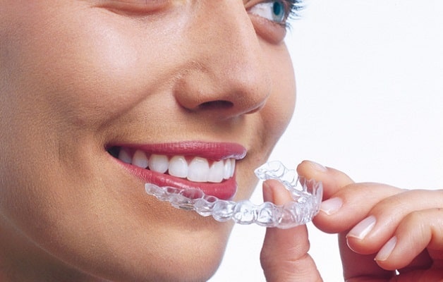 Đeo hàm duy trì là bước cuối của quy trình niêng răng chuẩn