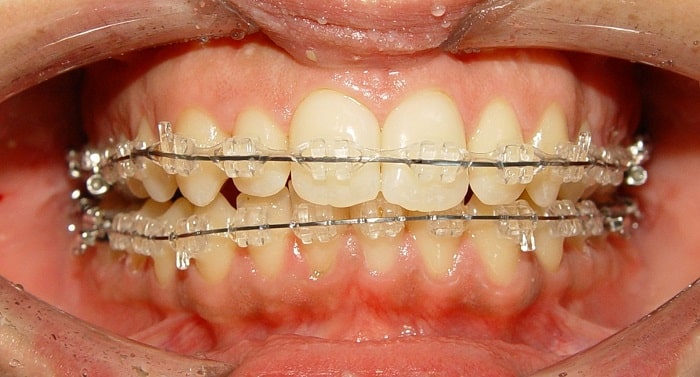 Hạn chế các bệnh về răng miệng