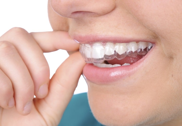 Răng mắc các bệnh lý khác như sâu răng, viêm nha chu, viêm nướu.