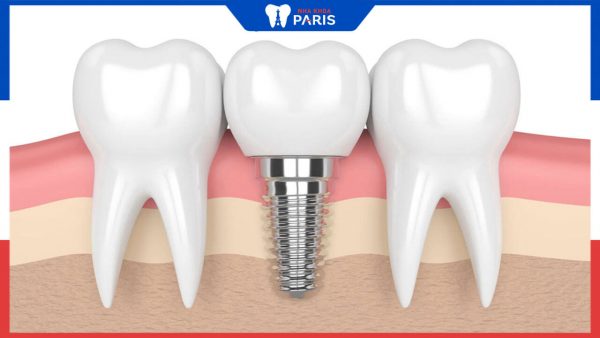 Tuổi thọ của răng Implant là bao lâu? Bác sĩ nha khoa paris trả lời