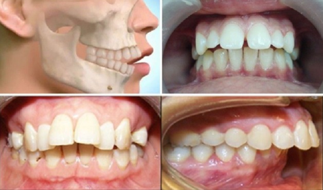 khớp cắn không chính xác dẫn đến răng bị hô mất thẩm mỹ