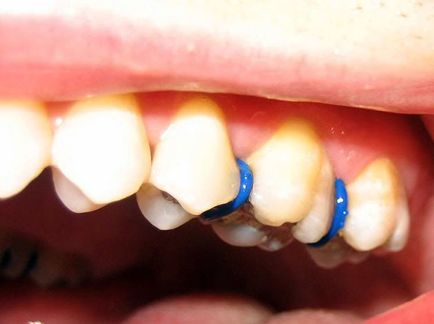 đau răng sau khi đặt thun giữa kẽ răng