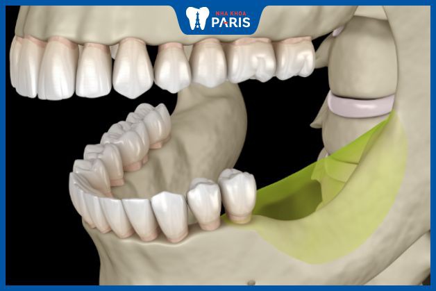Các bộ phận trong miệng suy yếu và dễ bị tấn công khi tiêu xương hàm
