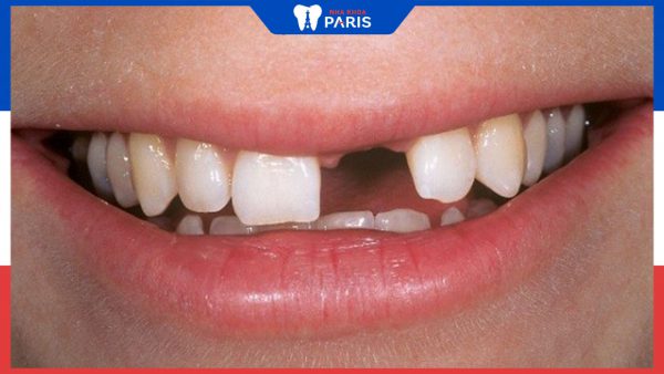 Tiêu xương răng: Nguyên nhân, hậu quả và cách chữa trị hiệu quả