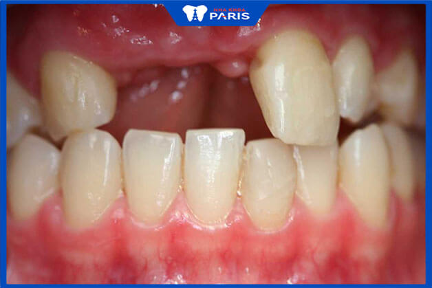 Tiêu xương ổ răng ảnh hưởng nghiêm trọng tới chức năng ăn nhai