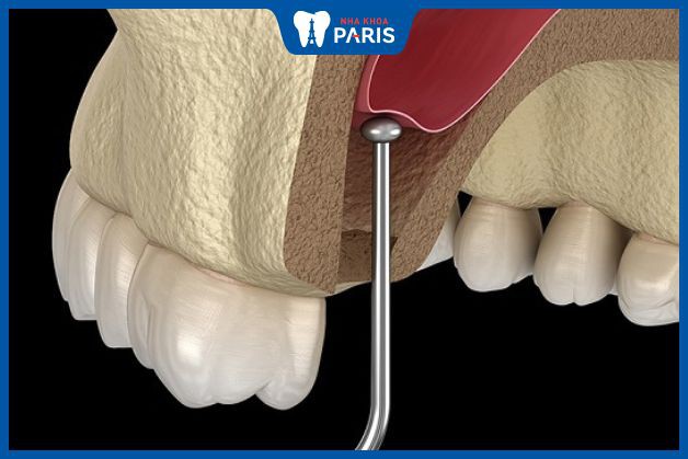 Ghép xương nâng xoang hàm khắc phục tiêu xương răng