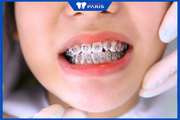 Tình trạng hiện tại của răng miệng anh hưởng tới giá của niềng răng
