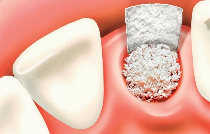 ngăn ngừa triệt để nguy cơ ổ răng tiêu biến trở lại.  