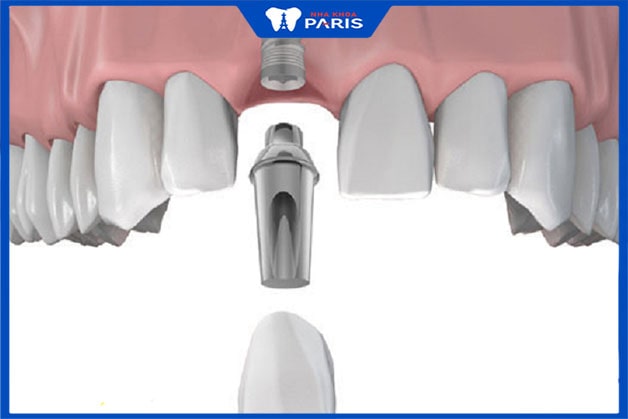 Trồng răng cửa implant có độ bền cao
