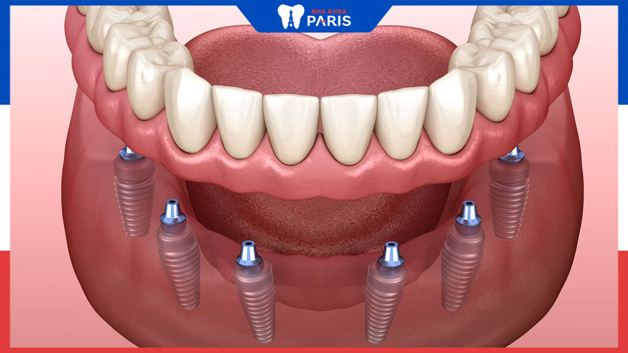 Trồng răng Implant All on 6 – Kỹ thuật phục hình toàn hàm hàng đầu