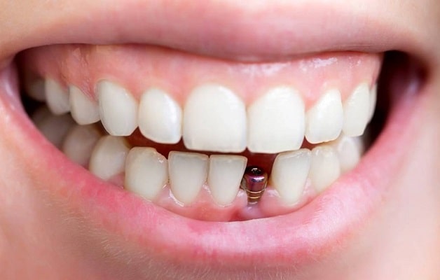Trồng răng implant phù hợp với nhiều người