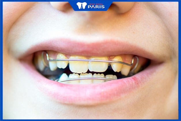 Niềng răng cho trẻ em giúp cải thiên chức năng ăn nhai
