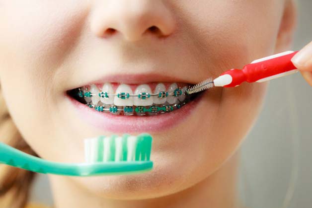 cách vệ sinh răng miệng khi niềng răng cho trẻ 7 tuổi