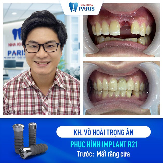 Răng implant giả trông không khác gì răng thật
