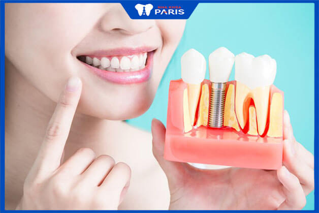 Độ bền của răng implant phụ thuộc vào các yếu tố