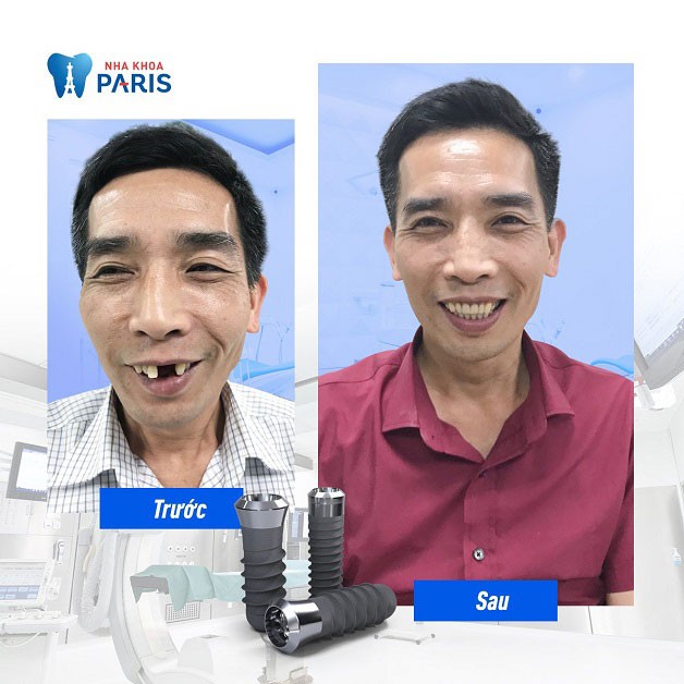 Trồng răng cửa implant phục hồi cả thẩm mỹ lẫn chức năng ăn nhai