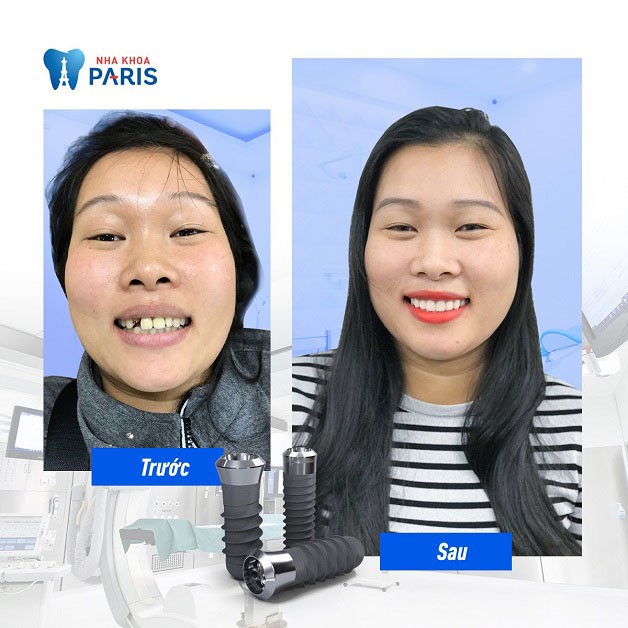 khách hàng trồng răng Implant tại nha khoa Paris