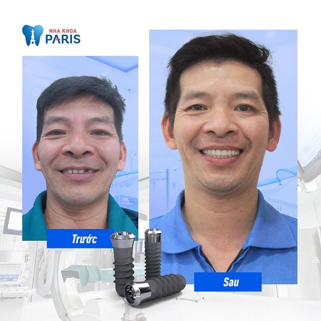 Implant nha khoa Paris đảm bảo về cả chất lượng lẫn hình thức