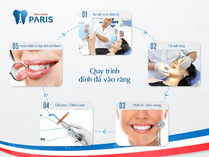 Quy trình đính đá vào răng an toàn tại Nha khoa Paris