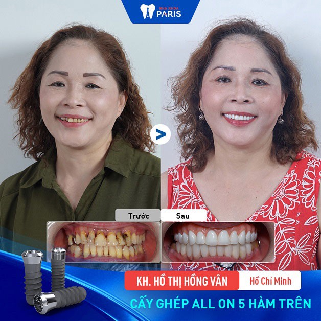 tKhách hàng Hồ Thị Hồng Vân trồng răng implant tại nha khoa Paris Hồ Chí Minh