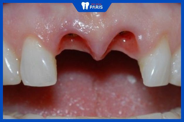 Khi bị gãy 2 răng cửa, trồng răng Implant là giải pháp tốt nhất