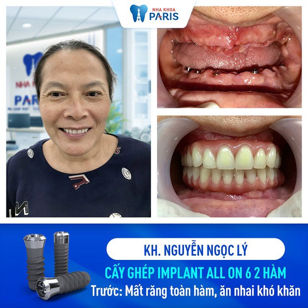 Cô Nguyễn Ngọc Lý cấy implant 6 cả 2 hàm