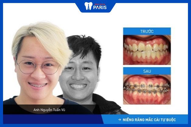Khách hàm niềng răng hàm lệch tại nha khoa Paris thay đổi bất ngờ chỉ sau 6 tháng.