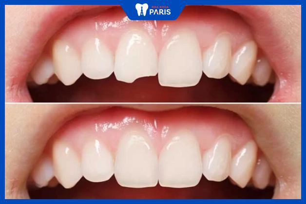 Khi gãy nửa răng cửa, có thể áp dụng trám răng để phục hình hiệu quả