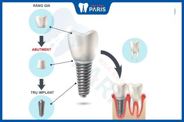 Abutment là phần nối giữa răng sứ và trụ implant