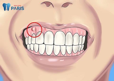 Áp xe nướu răng có thể lây lan tới các bộ phận khác gây ra những hậu quả nghiêm trọng