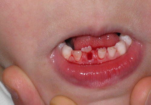 bé 18 tháng bị chảy máu chân răng là bệnh gì