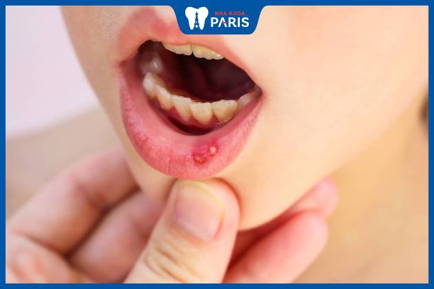 Bệnh lở miệng có nguy hiểm không?